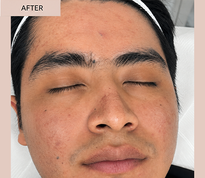 ACNE 1 AFTER