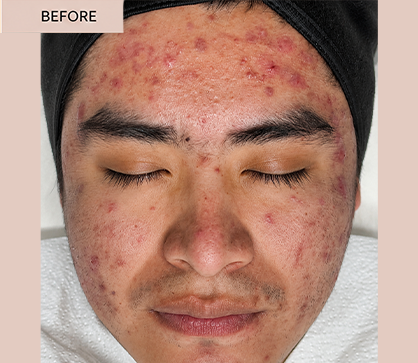ACNE 1 BEFORE