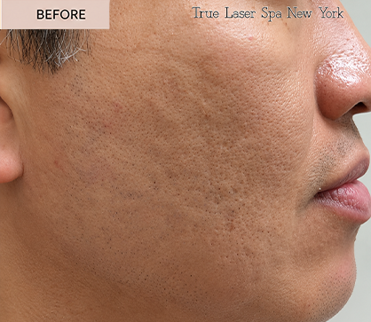 ACNE 2 BEFORE