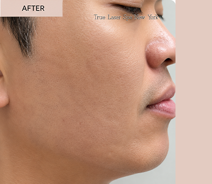 ACNE 2 aft