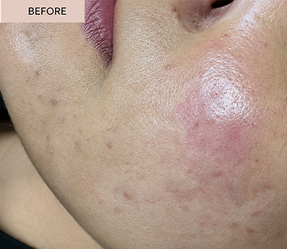 ACNE 3 BEFORE