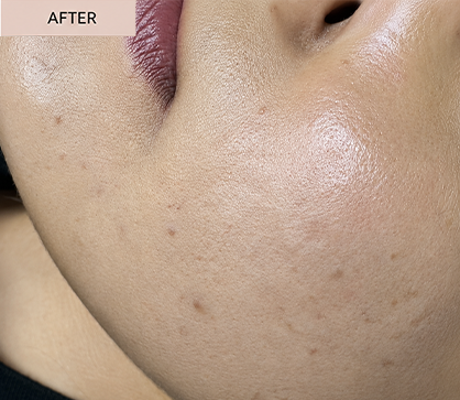 ACNE 3 aft